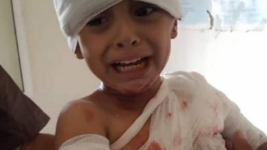 صورة إصابة طفلين بشظايا حوثية في البيضاء اليمنية