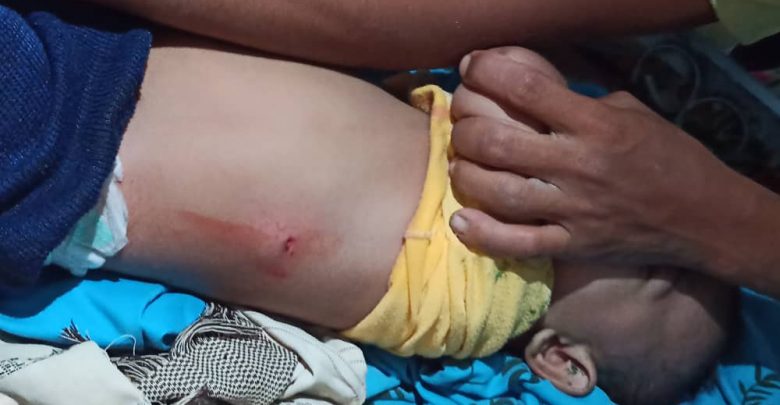 إصابة طفل برصاص مليشيا الحوثي في مديرية حيس