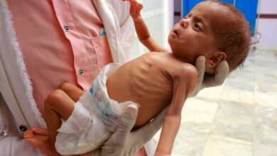 صورة الأمم المتحدة: 7.6 مليون شخص في اليمن بحاجة إلى خدمات لعلاج سوء التغذية